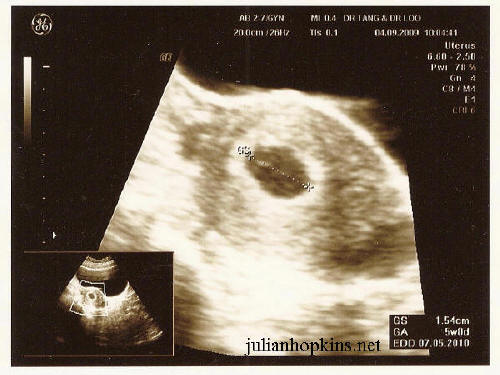 sonogram 5 weeks. pregnancy ultrasound five 5