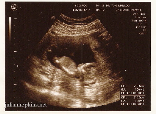pregnancy ultrasound thirteen 13 weeks