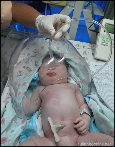 سندرم زجر تنفسی نوزاد: Infant  Respiratory    Distress    Syndrome   